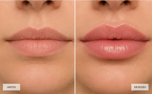 Resultado antes y después de Labios en SkinClinic Madrid