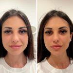 Aumento de Mentón 1 ml